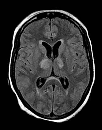 日本脳炎 MRI FLAIR像 軸位断 両側視床の高信号