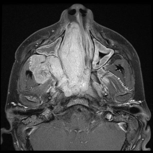 若年性血管線維腫 MRI 造影T1強調脂肪抑制像 横断像