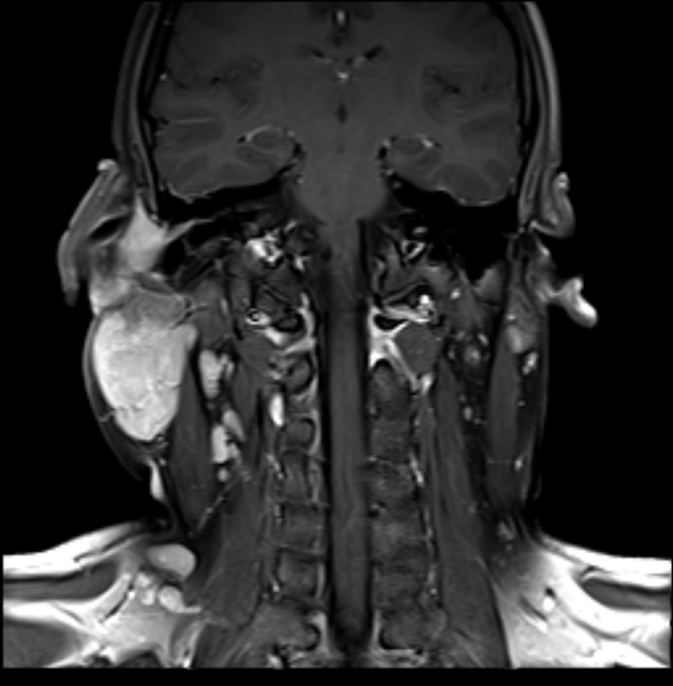 木村病 造影MRI(脂肪抑制T1強調像) 冠状断