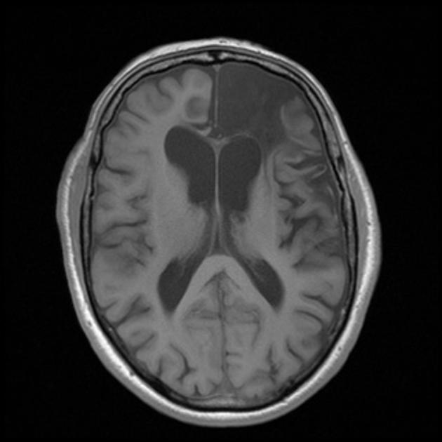 脳梗塞後の皮質T1高信号 MRI T1強調像 横断像