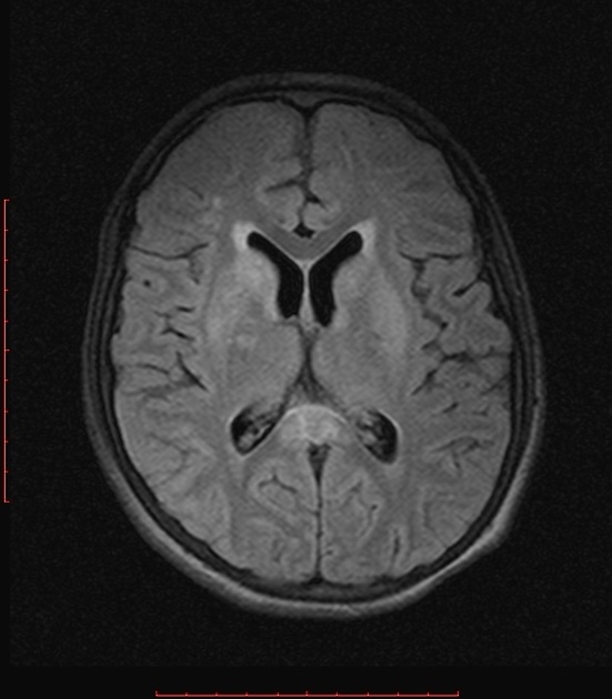 Leigh脳症 MRI FLAIR像 横断像