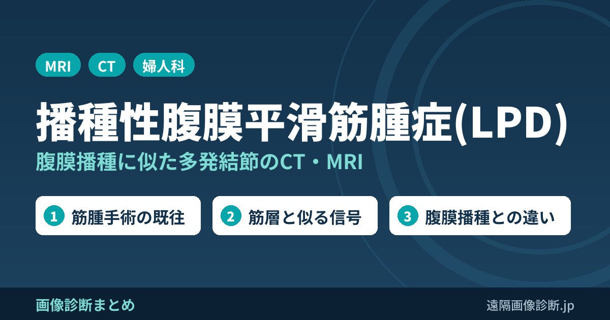 播種性腹膜平滑筋腫症(LPD) 腹膜播種に似た多発結節のCT・MRI