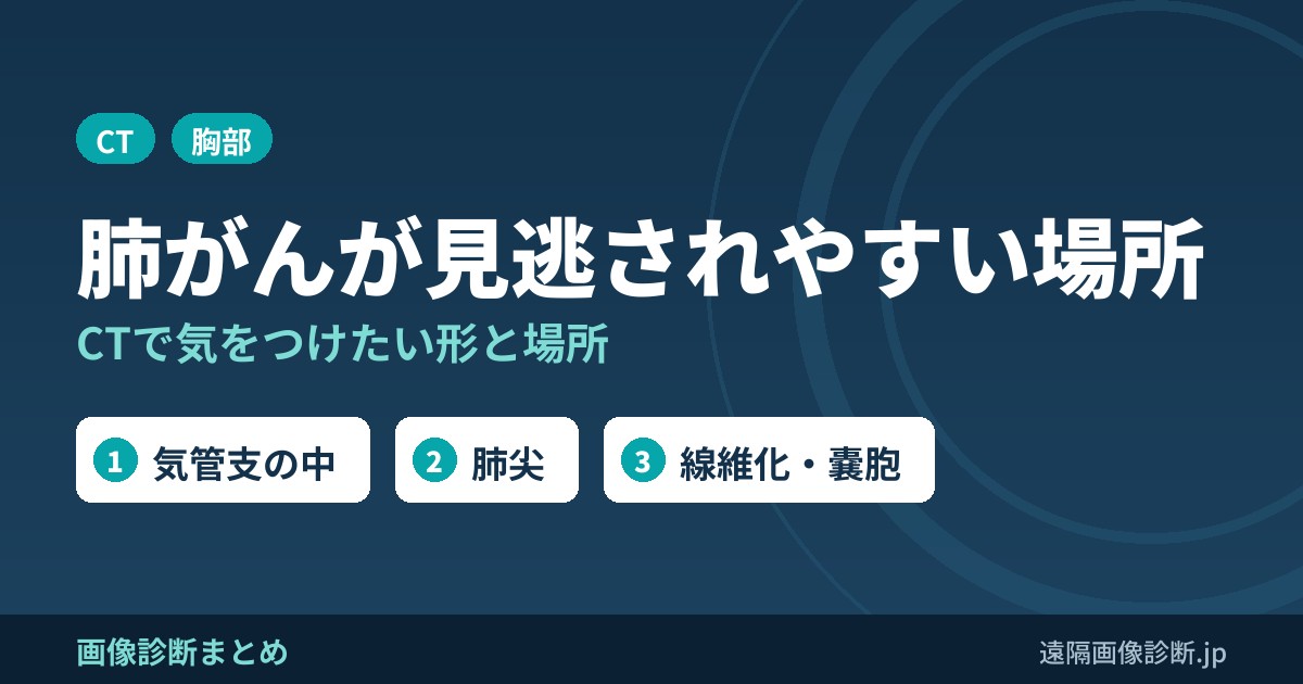 肺がんが見逃されやすい場所 CTで気をつけたい形と場所