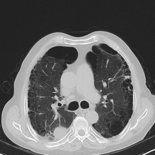 特発性肺線維症に合併した肺がん CT 肺野条件 横断像