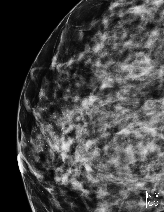 乳房の石灰化 マンモグラフィ 右CC拡大像 区域性の淡く不明瞭・多形性石灰化