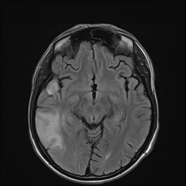 MELAS MRI FLAIR像 横断像