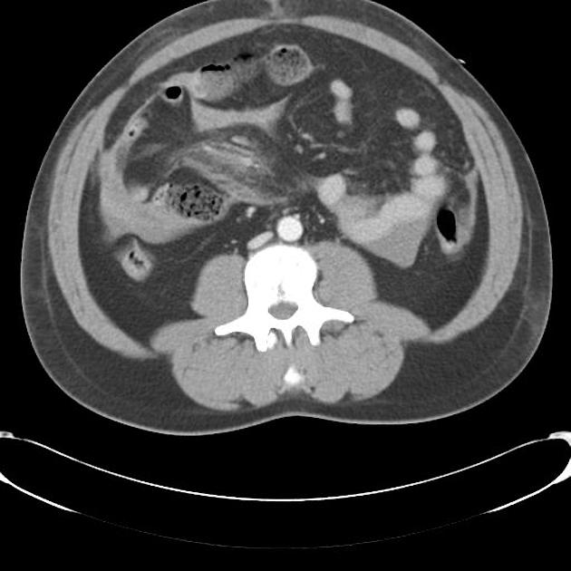 腸間膜損傷 sentinel clot sign 造影CT 横断像
