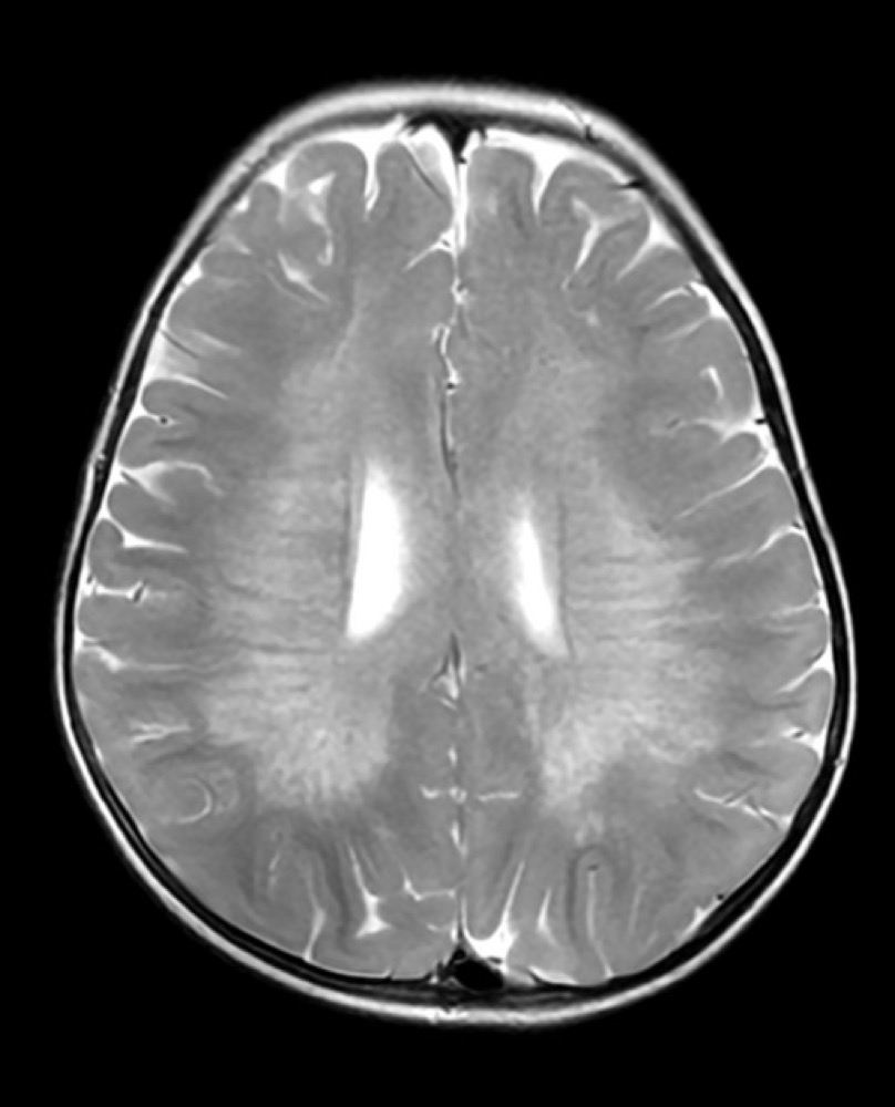 異染性白質ジストロフィー MRI T2強調像 横断像