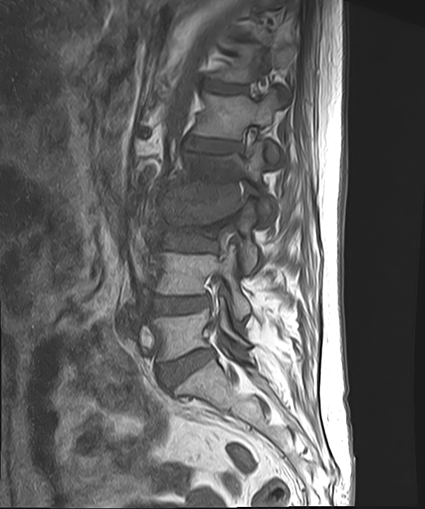 化膿性椎間板炎・椎体炎 MRI 矢状断 T1強調像