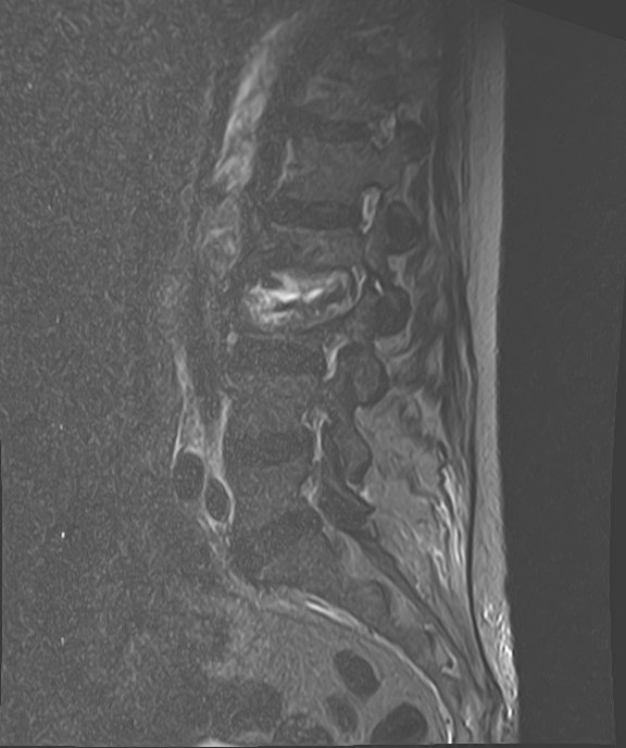 化膿性椎間板炎・椎体炎 MRI 矢状断 STIR