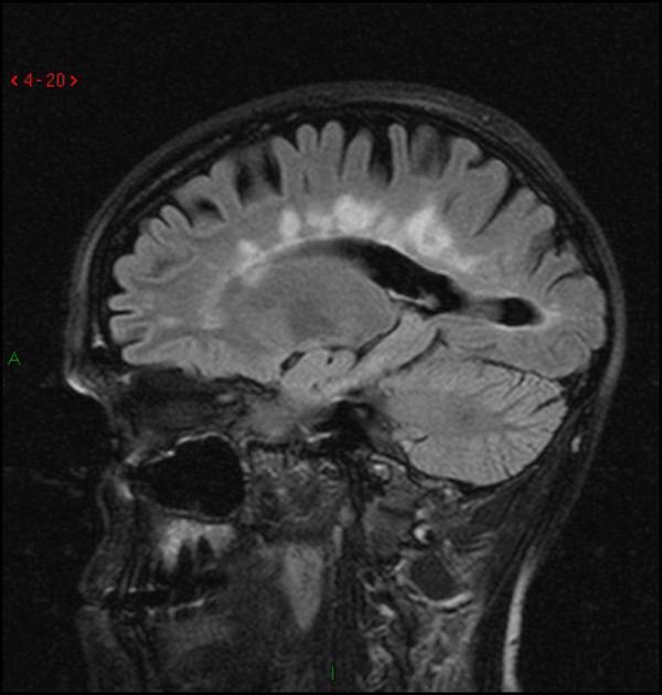 多発性硬化症 MRI FLAIR像 矢状断