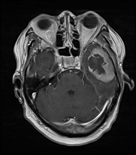 骨髄肉腫(緑色腫) 造影MRI T1強調 横断像