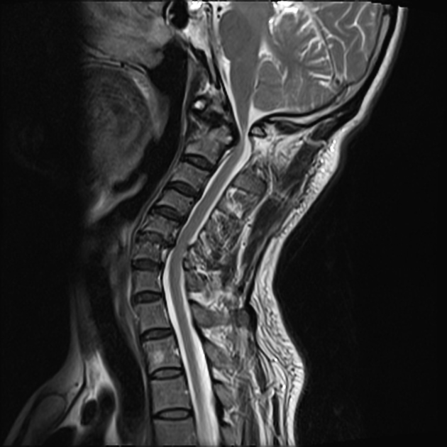脊髄軟化症 MRI T2強調像 矢状断像