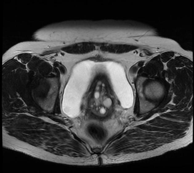 ナボット嚢胞 MRI T2強調像 横断像