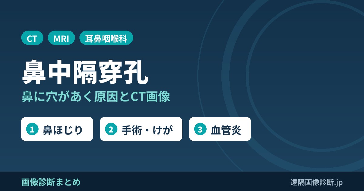 鼻中隔穿孔 鼻に穴があく原因とCT画像