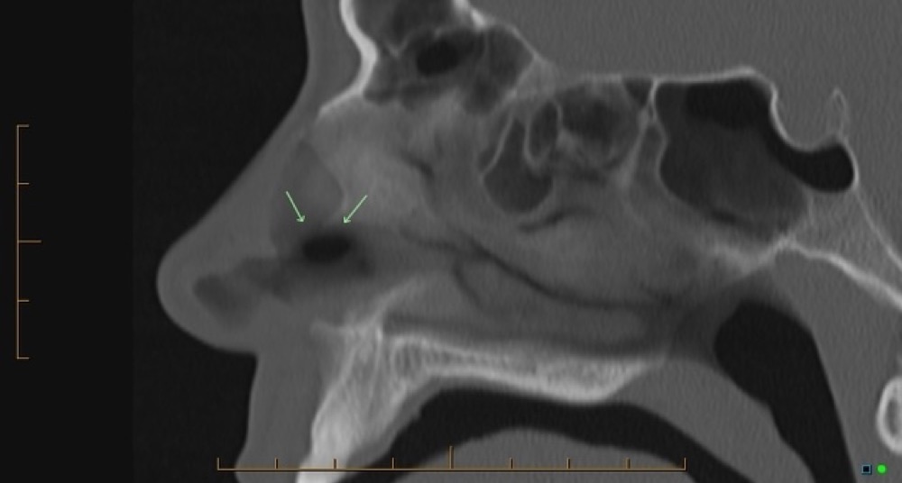 鼻中隔穿孔 CT 矢状断像