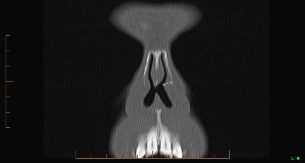鼻中隔穿孔 CT 冠状断像
