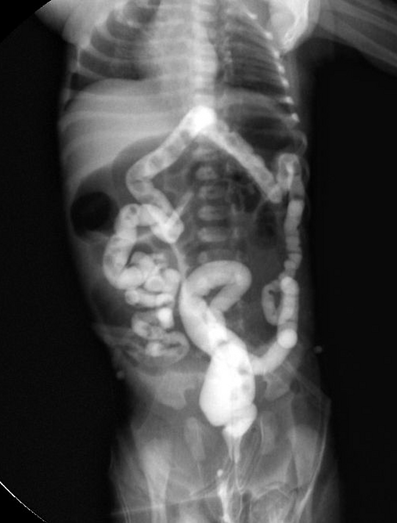 胎便性イレウス 新生児 注腸造影 microcolon