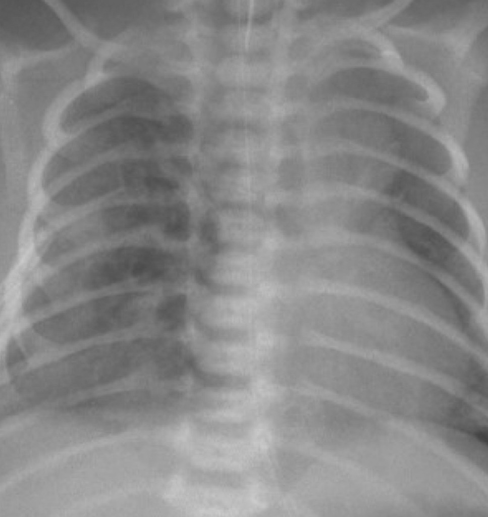 新生児 RDSに合併した気胸と間質性肺気腫 胸部X線