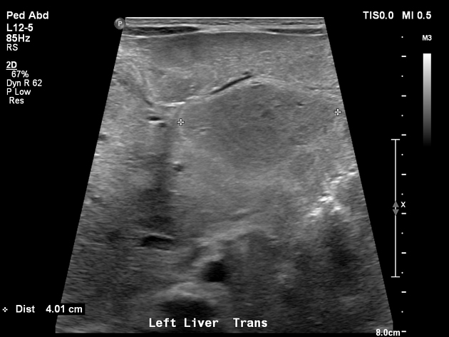 乳児肝血管腫 生後22日男児 肝臓の超音波像