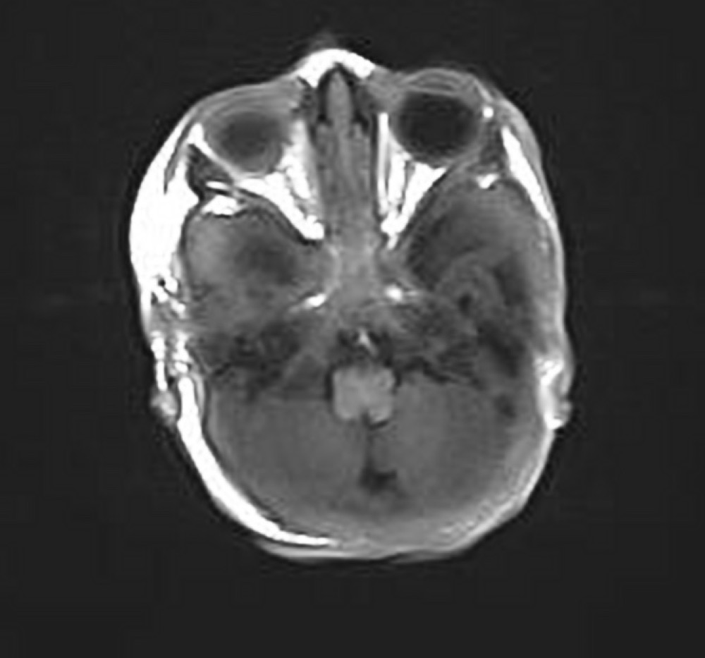神経皮膚黒色症 MRI T1強調像 横断像