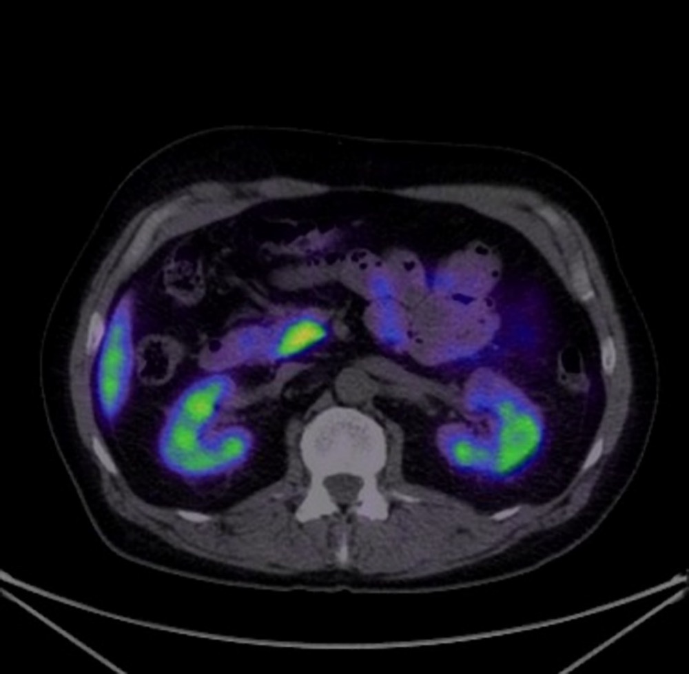 Ga-68 DOTATATE PET/CT 融合画像 横断像 膵鈎部の生理的集積