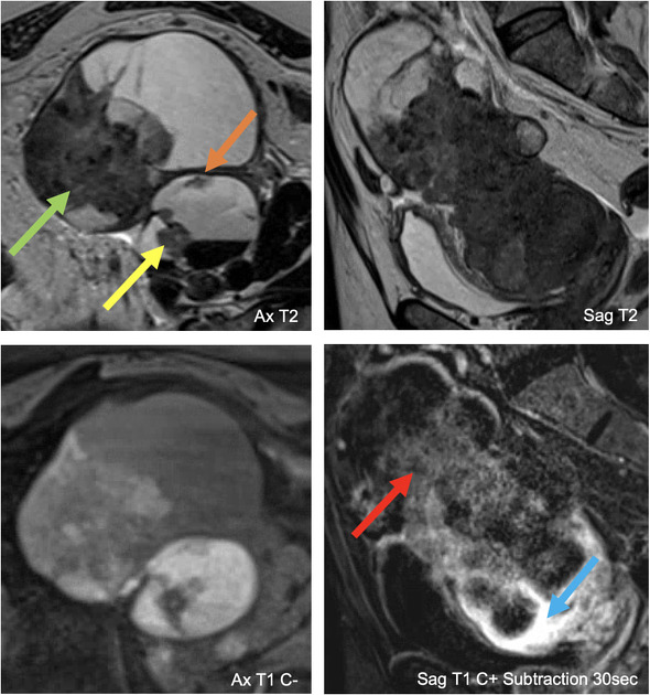 卵巣類内膜腺癌(O-RADS MRI 4) 骨盤MRI 横断像・矢状断像