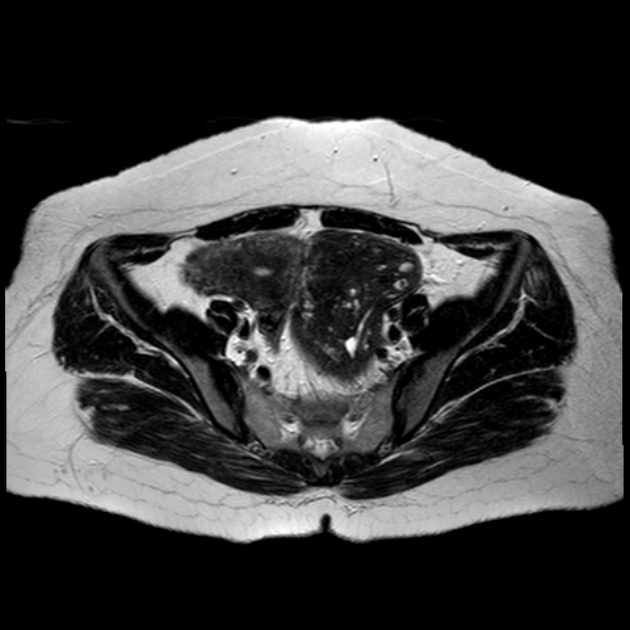 卵巣線維腫 MRI T2強調像
