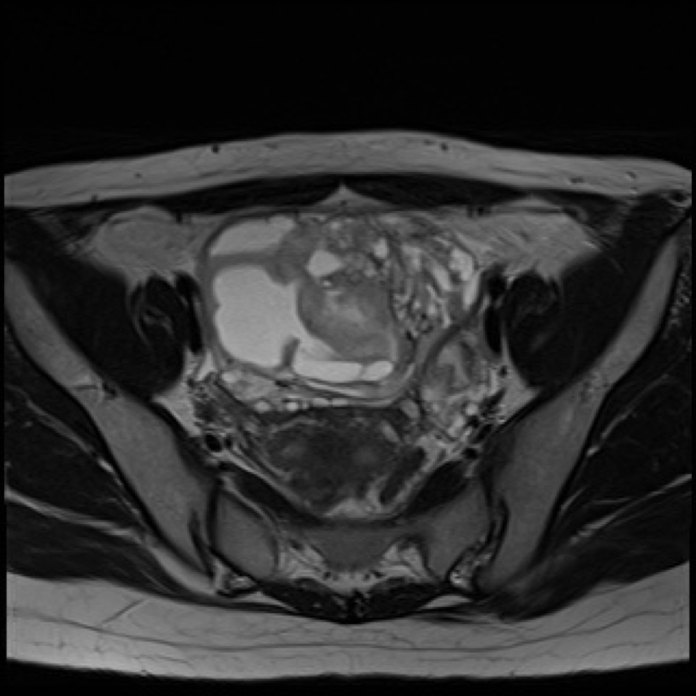 未熟奇形腫 MRI T2強調像 横断像