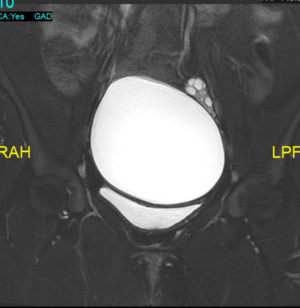 傍卵巣嚢胞 MRI 脂肪抑制T2強調像 冠状断像