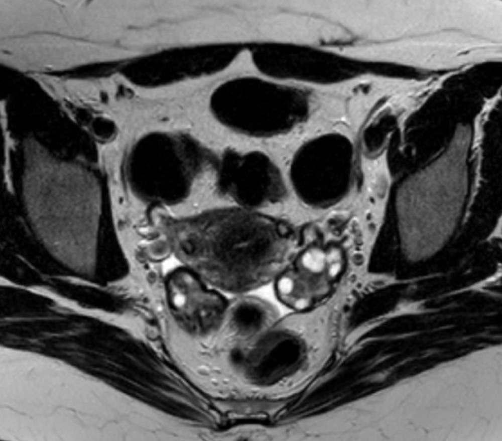 多嚢胞性卵巣症候群 MRI T2強調像 横断像