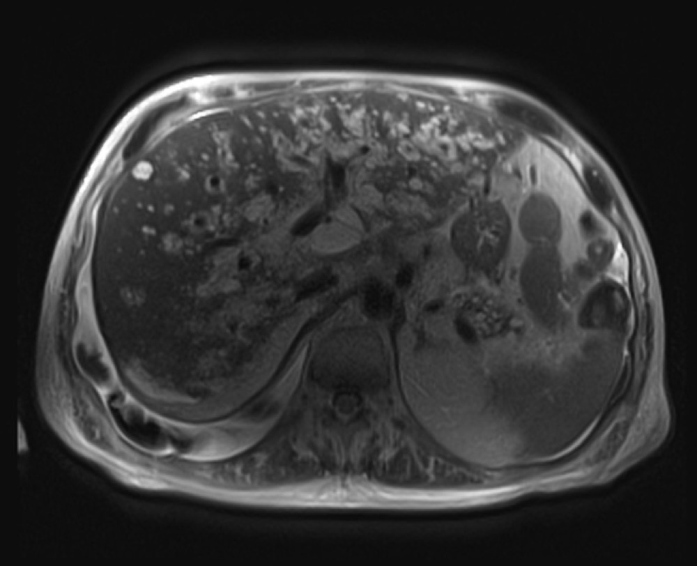 肝紫斑病 MRI 横断像