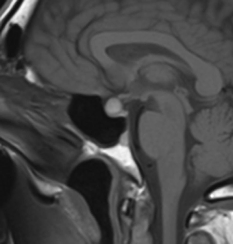 ラトケ嚢胞 MRI T1強調像 矢状断像