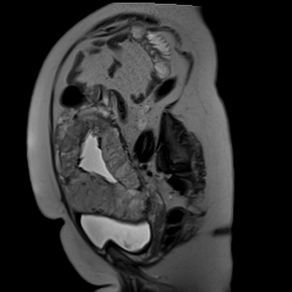 癒着胎盤 MRI T2強調像(HASTE) 矢状断像