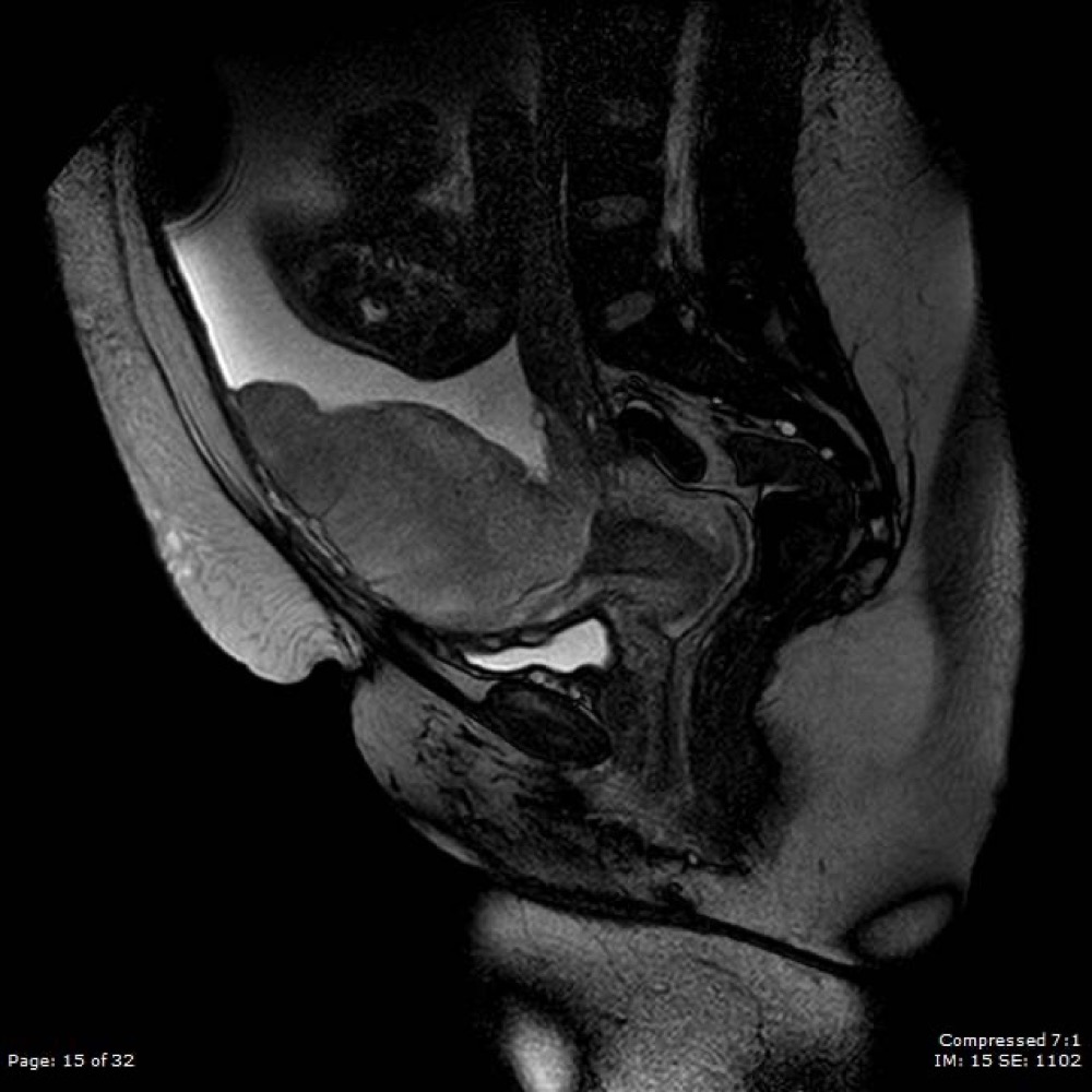 全前置胎盤 MRI T2強調像 矢状断像