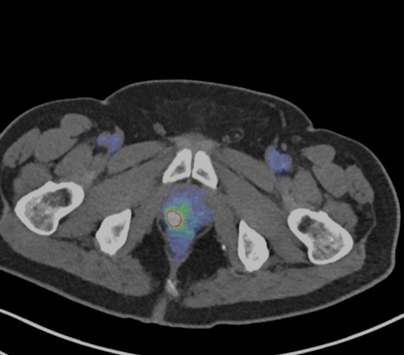 前立腺癌 PSMA PET/CT 軸位断