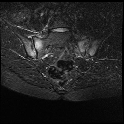 両側急性仙腸関節炎 MRI 冠状断像