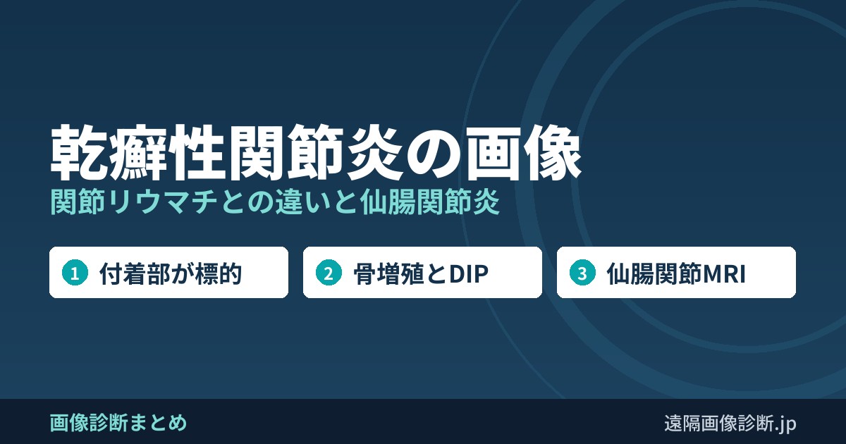 乾癬性関節炎の画像 関節リウマチとの違いと仙腸関節炎