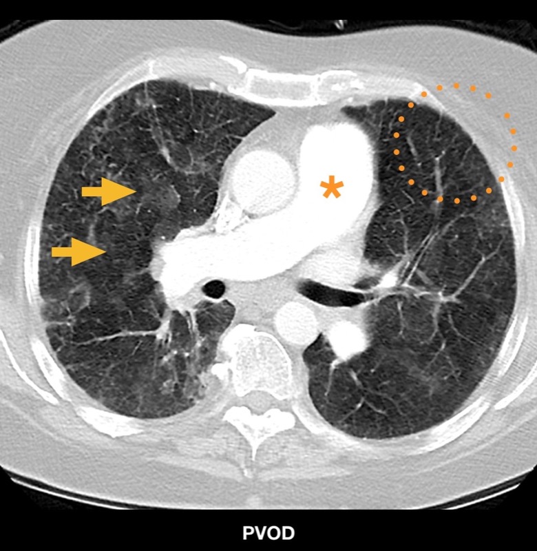 肺静脈閉塞症(PVOD) CT 横断像