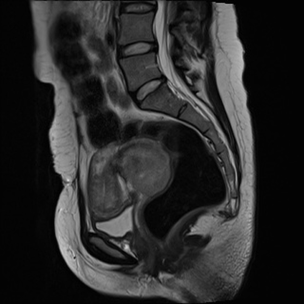 子宮頸部筋腫 MRI T2強調像 矢状断像