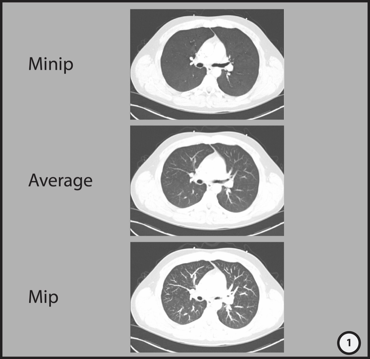 胸部CT MinIP・平均・MIP像の比較