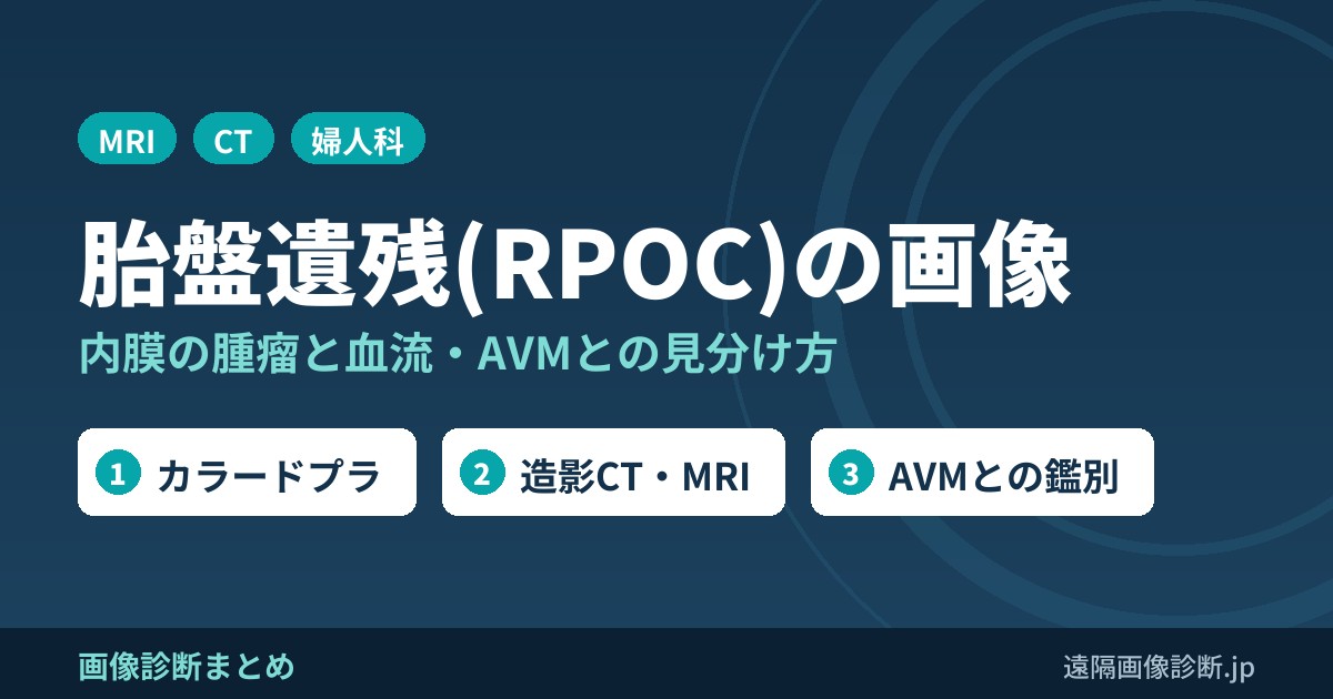 胎盤遺残(RPOC)の画像 内膜の腫瘤と血流・AVMとの見分け方