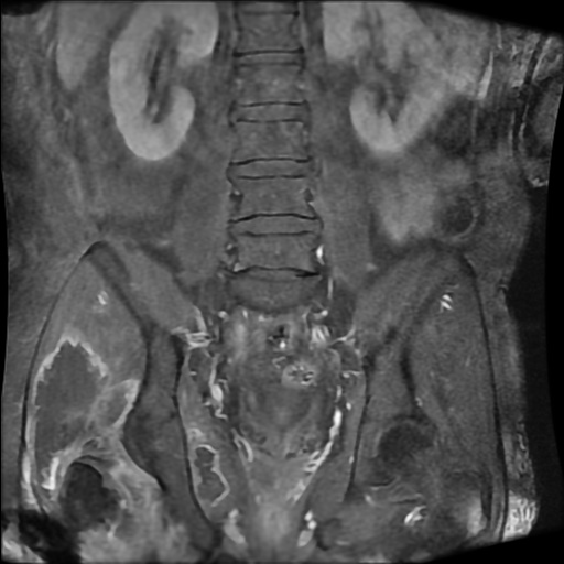 横紋筋融解症 MRI 造影後脂肪抑制T1強調像 冠状断像