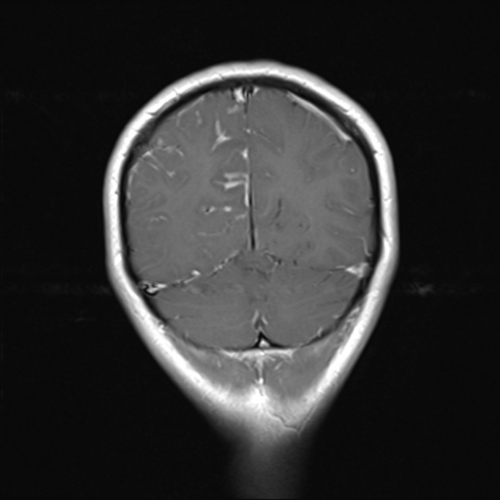 リウマチ性髄膜炎 MRI 造影T1強調像 冠状断像