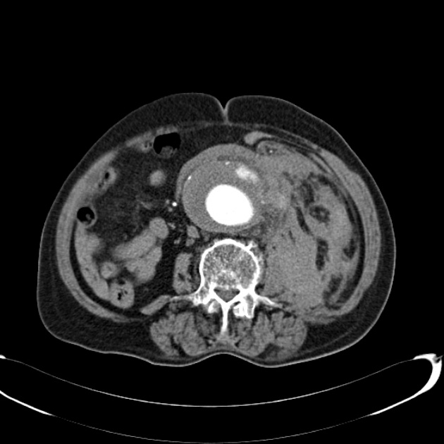 腹部大動脈瘤破裂 造影CT(動脈相) 横断像