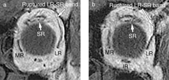 サギングアイ症候群 眼窩MRI T1強調 準冠状断像