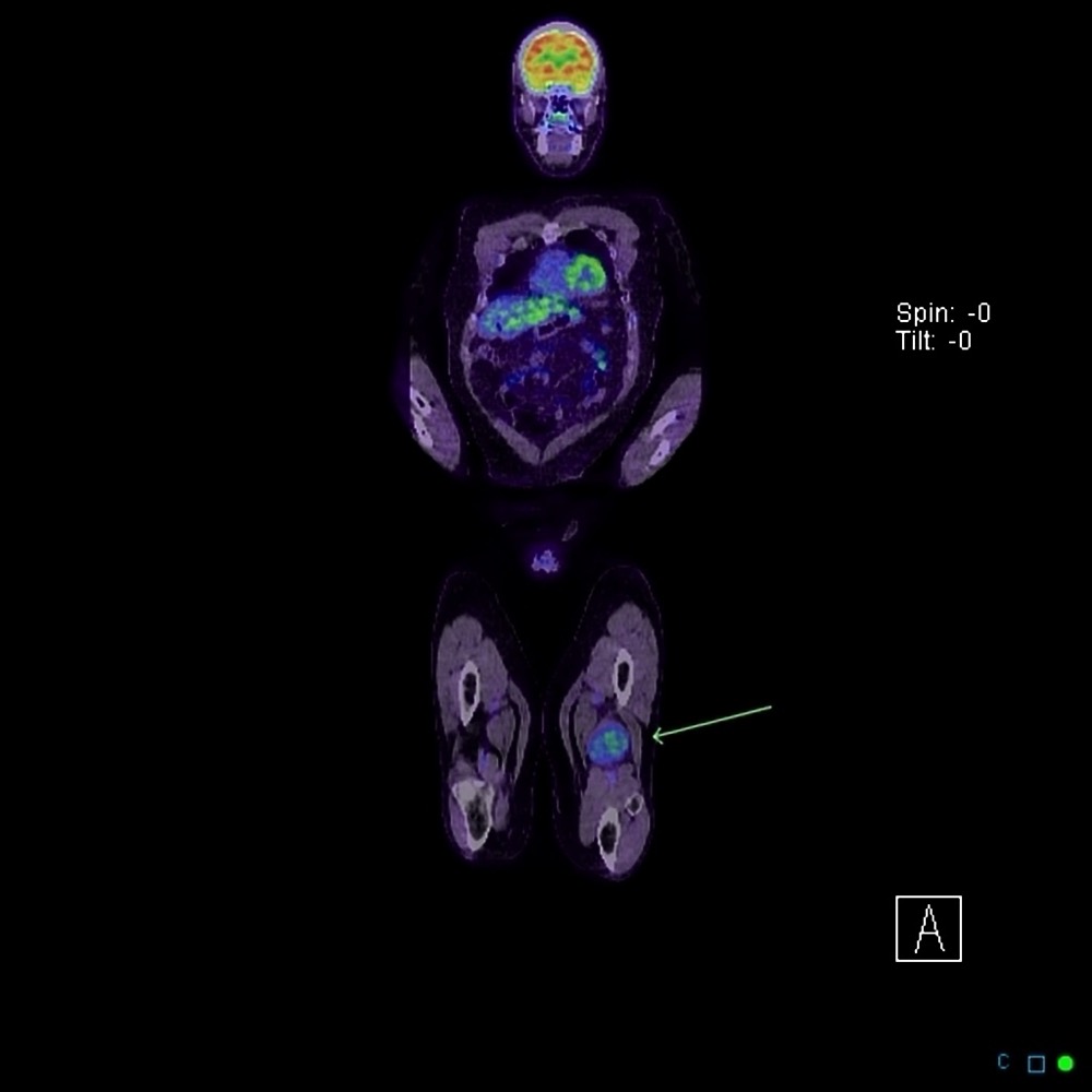 膝窩の神経鞘腫 FDG-PET/CT 冠状断像