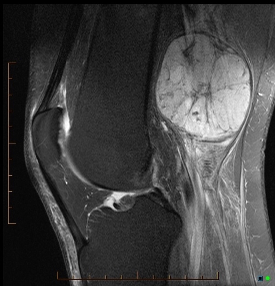 膝窩の神経鞘腫 MRI 脂肪抑制T2強調像 矢状断像