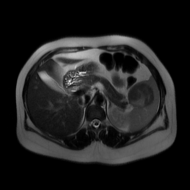 脾臓SANT MRI T2強調像 横断像