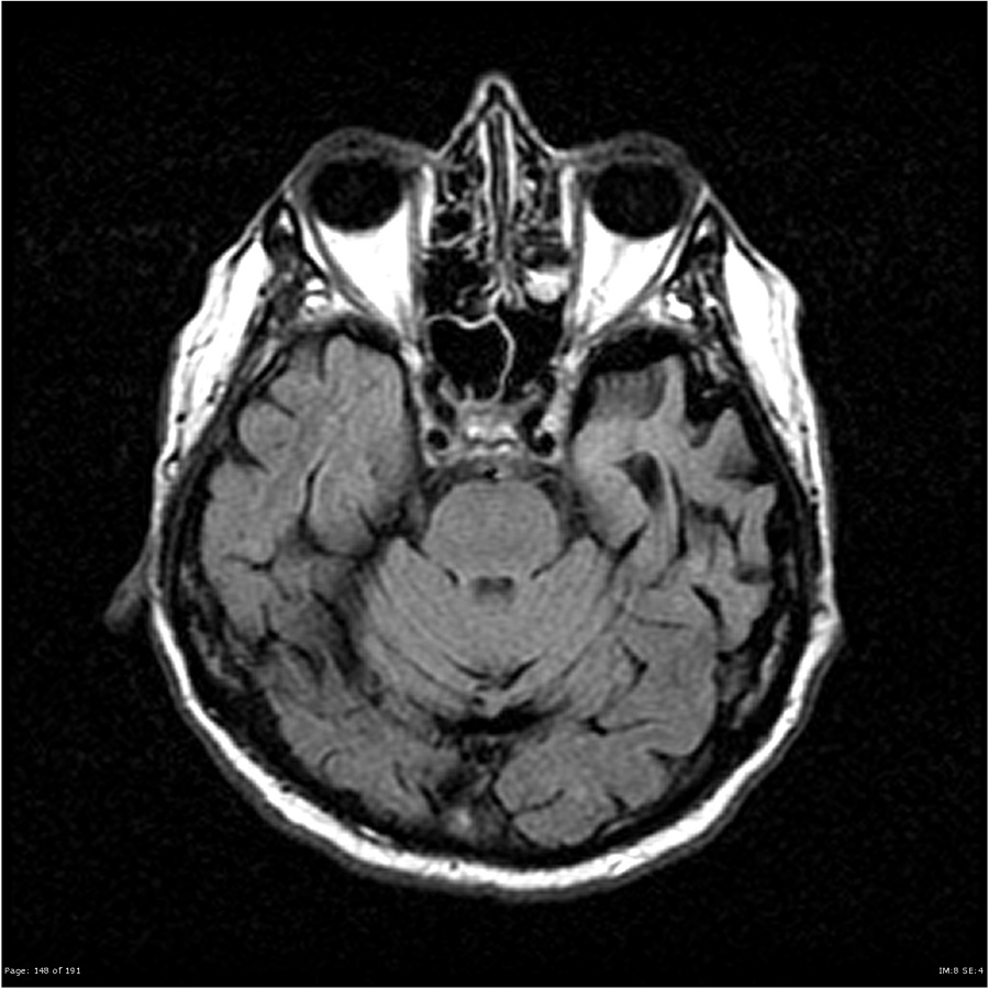 意味性認知症 MRI FLAIR 横断